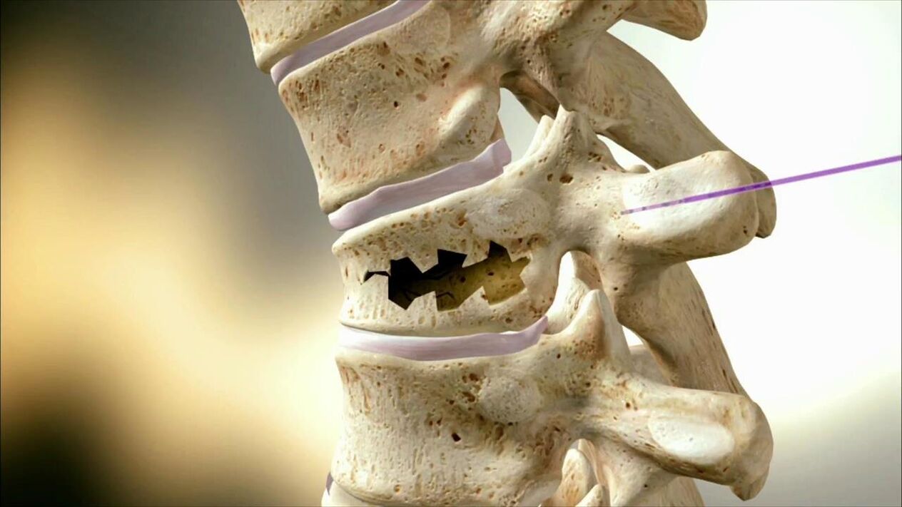 Damaged spine disk