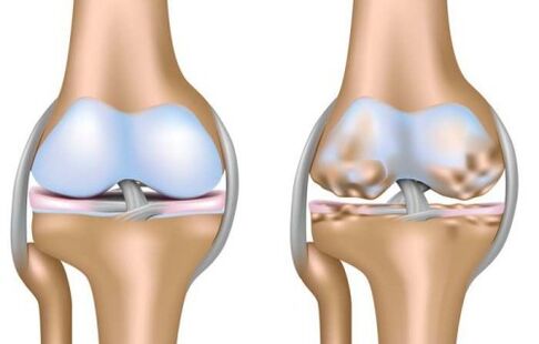 healthy joint and destruction of the knee joint due to arthrosis
