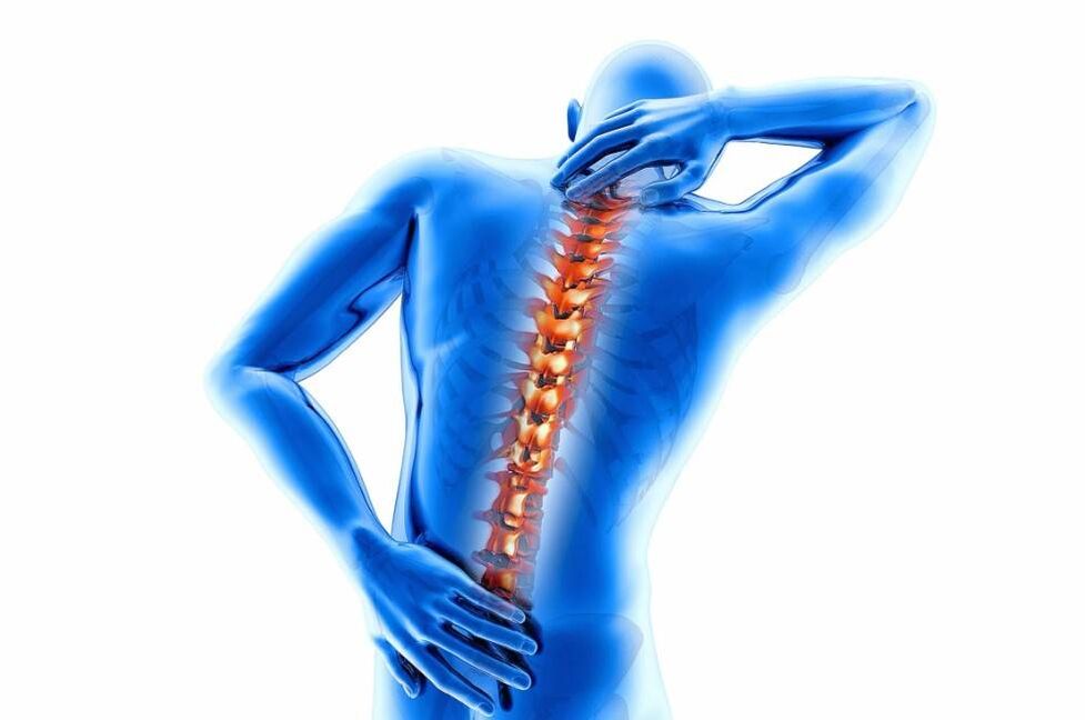 The disease osteochondrosis is accompanied by thinning of the intervertebral discs