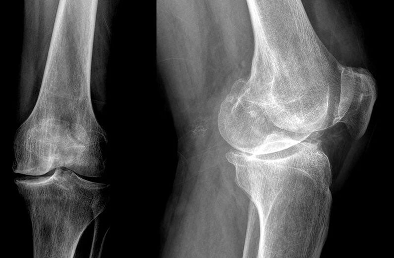 diagnosis of joint arthrosis